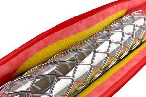 血管成形术医疗设备的E&L测试图像。Jordi实验室专门从事医疗器械的可提取物和可浸出物（E&L）测试。乐动体育登录